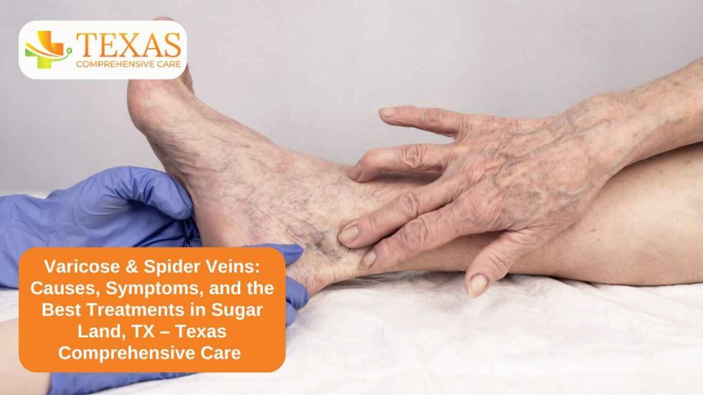 Varicose & Spider Veins- Causes, Symptoms, and the Best Treatments in Sugar Land, TX – Texas Comprehensive Care
